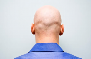 Calling a man ‘bald’ is s*xual harassment, employment tribunal rules