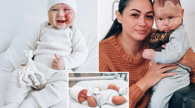 TikTok Trolls labels mum a ‘monster’ for lasering port-wine stain birthmark on her baby’s face